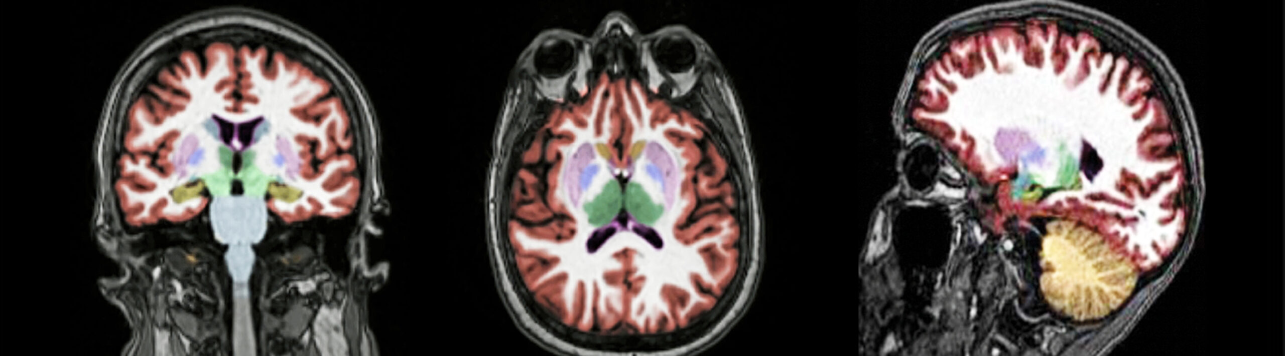 neuroquant-hero-1 Patients and Providers MRI